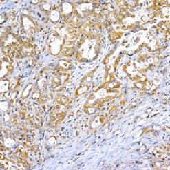 Formalin fixed paraffin embedded human breast carcinoma stained with TNF Alpha.