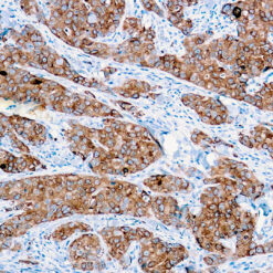Formalin fixed paraffin embedded human breast carcinoma stained with CA 15-3