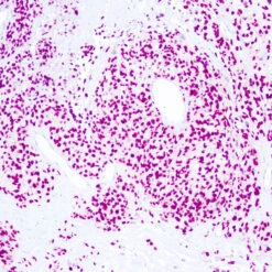 Formalin fixed paraffin embedded human melanoma stained with SOX-10.