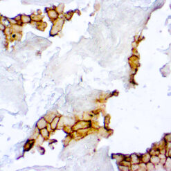 Formalin fixed paraffin embedded squamous lung carcinoma stained with PD-L1.