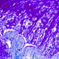 Human colon tumor stained with Mucicarmine kit (KT024).