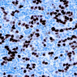 Formalin fixed paraffin embedded breast carcinoma stained with Progesterone Receptor antibody.
