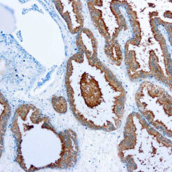 Formalin fixed paraffin embedded human prostate stained with PSA antibody.