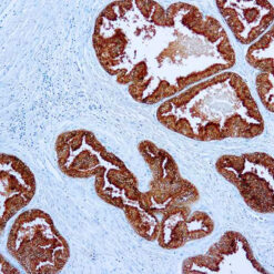 Formalin fixed paraffin embedded human Prostate carcinoma stained with PSAP