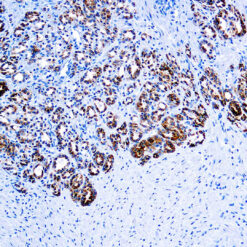 Formalin fixed paraffin embedded human prostate carcinoma stained with .