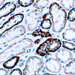 Formalin fixed paraffin embedded human renal cell carcinoma stained with Cadherin, Pan