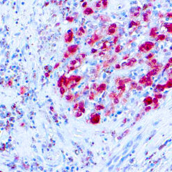 Formalin fixed paraffin embedded human melanoma stained with S-100 antibody.
