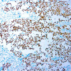Formalin fixed paraffin embedded human seminoma stained with SALL4