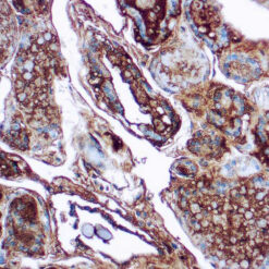 Formalin fixed paraffin embedded thyroid stained with Thyroglobulin antibody