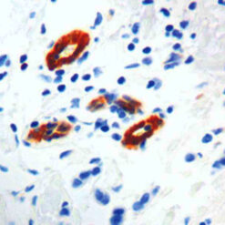 Formalin fixed paraffin embedded breast carcinoma stained with Transglutaminase II antibody.