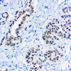Formalin fixed paraffin embedded Wilms tumor stained with WT-1 antibody