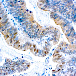 Formalin fixed paraffin embedded ovarian cancer stained with BRCA1