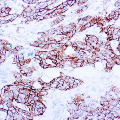 Formalin fixed paraffin embedded human breast carcinoma stained with c-erbB-2 antibody