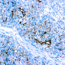 Formalin fixed paraffin embedded ovarian carcinoma stained with CA 125