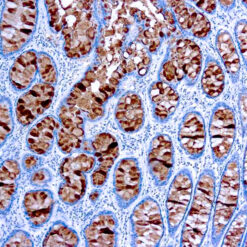 Formalin fixed paraffin embedded colon cancer stained with CA 19-9