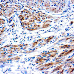 Formalin fixed paraffin embedded endometrial cancer stained with Caldesmon
