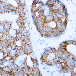 Formalin fixed paraffin embedded human breast carcinoma stained with E-Cadherin antibody.
