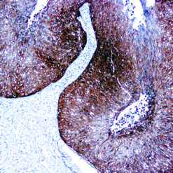 Formalin fixed paraffin embedded HPV and cervical cancer stained with p16.