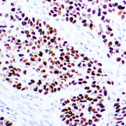 Formalin fixed paraffin embedded human lung squamous cell carcinoma stained with p40 antibody.