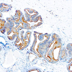 Formalin fixed paraffin embedded prostate carcinoma stained with antibody.