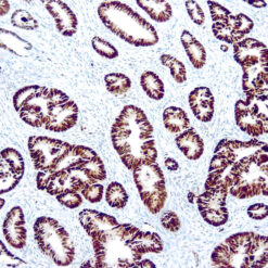 Formalin fixed paraffin embedded colon carcinoma stained with p53 antibody.