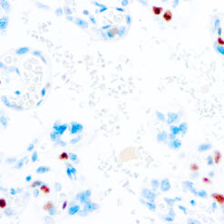 Formalin fixed paraffin embedded colon carcinoma stained with p57Kip2 antibody