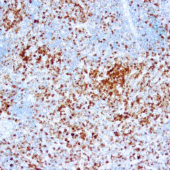 Formalin fixed paraffin embedded anaplastic lymphoma kinase stained with ALK/p80
