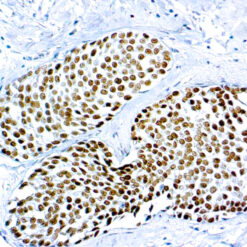 Formalin fixed paraffin embedded breast carcinoma stained with GATA-3.
