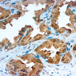 Formalin fixed paraffin embedded human prostate carcinoma stained with Galectin-3.