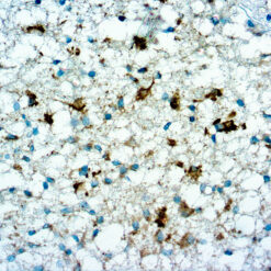 Formalin fixed paraffin embedded Anaplastic Oligodendrogliom stained with IDH1.