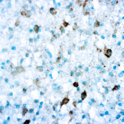 Formalin fixed paraffin embedded Anaplastic Oligodendrogliom stained with IDH1.