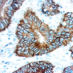 Formalin fixed paraffin embedded human colon carcinoma stained with MOC-31.