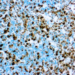 Formalin fixed paraffin embedded rhabdomyosarcoma stained with ALK