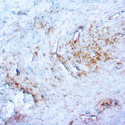 Formalin fixed paraffin embedded human T.Pallidum Siphsis infected tissue stained with T.Pallidum.