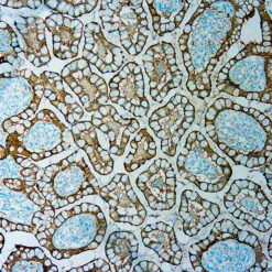 Formalin fixed paraffin embedded human Colorectal carcinoma stained with Villin