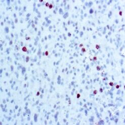 Formalin fixed paraffin embedded Melanoma stained with PHH3.