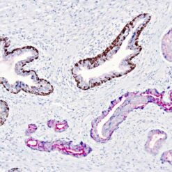 Formalin fixed paraffin embedded human prostate carcinoma stained with Prostate Cocktail.
