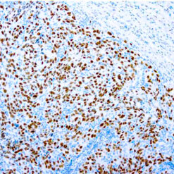 Formalin fixed paraffin embedded human melanoma stained with SOX-10 antibody
