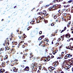 Formalin fixed paraffin embedded human colon carcinoma stained with Cytokeratin 20 antibody