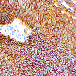 Formalin fixed paraffin embedded human bladder carcinoma stained with CD44, HCAM antibody.