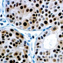 Formalin fixed paraffin embedded human colon carcinoma stained with p27Kip1 antibody.
