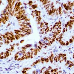 Formalin fixed paraffin embedded human colon carcinoma stained with MSH6 antibody.