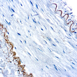 Formalin fixed paraffin embedded human renal cell carcinoma stained with Elastin antibody.