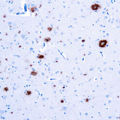 Formalin fixed paraffin embedded amyloidosis stained with β-Amyloid Protein