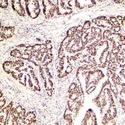 Formalin fixed paraffin embedded colon adenocarcinoma stained with PMS2.