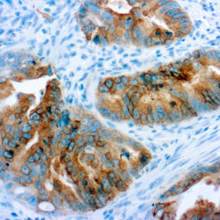 Formalin fixed paraffin embedded colon carcinoma stained with COX-2 antibody.