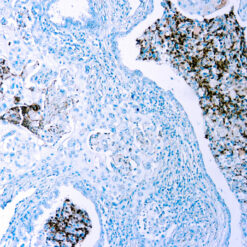 Formalin-fixed paraffin embedded human Lung Carcinoma stained with A20