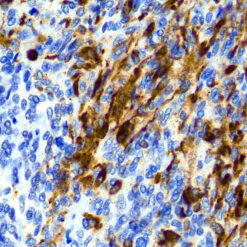 Formalin fixed paraffin embedded human Mesothelioma stained with Calretinin (H-5)