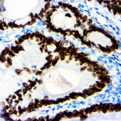 Formalin fixed paraffin embedded human colon carcinoma stained with SATB2