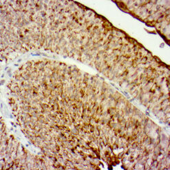 Formalin fixed paraffin embedded human Bladder carcinoma stained with Uroplakin II (UPK2)
